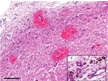 Figure 5. Perivascular erthrocyte diapedehsis in gray matter.  Erythrophagocytosis and hemosiderin-laden microglias ( right  lower image )