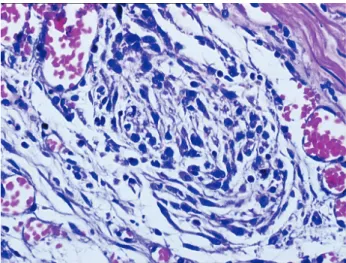 Figure 2. Immunohistochemically, cytoplasm of the tumour  cells stained as dark red in colour with anti vimentin sera