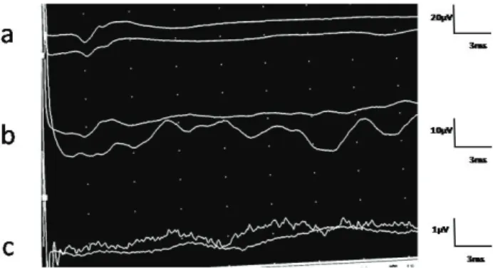 Figure 1. Normal potentials from the lumbar (a), thoracic (b)  and scalp area (c) (In a case without history of spinal disorders)