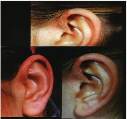 Şekil 2: Kobay sahibinde kulak kenarlarında görülen dermatik değişiklikler: skuamatöz deskuamasyon ve bazal eritamatoz