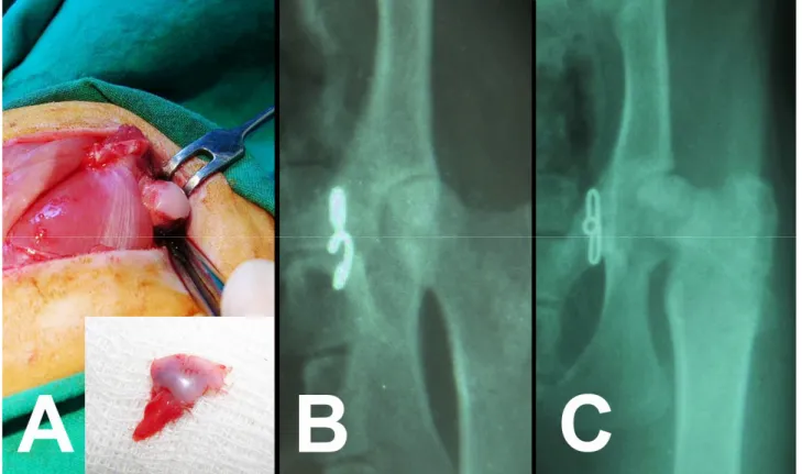 Şekil 2.A. Olgu no: 17’de lig. capitis femoris’in yapışma yerindeki avulsiyon kırığının intraoperatif görünümü; caput femoris’in  ventral kısmından çıkartılan parça (sağ alt köşedeki küçük resim), B