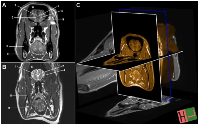 Figure 1. MR images of the brain at the level of caudate nuclei in transversal plane. A-) T1W, B- T2W, C-) T1W, 3D-IR-MPR  volumetric images