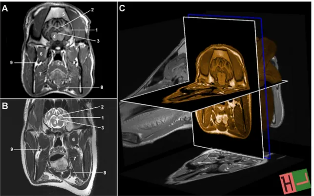 Şekil 2. Transversal düzlemde, hypophysis düzeyinde, beynin MR görüntüleri, A-) T1-ağırlıklı, B-) T2-ağırlıklı, C- T1-ağırlıklı, 3D- 3D-IR-MPR volumetrik görüntüler