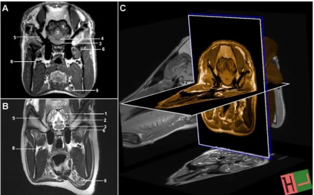 Figure 5. MR images of the brain at three levels in sagittal plane. A-) T1W, B-) T1W, 3D-IR-MPR volumetric images