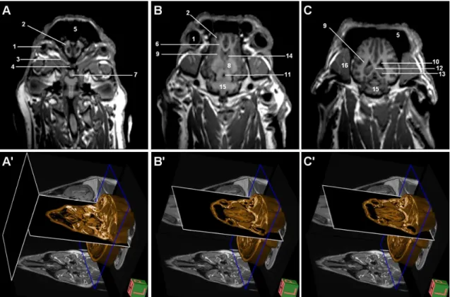 Figure 6. MR images of the brain at three levels in frontal plane. A-) T1W, B-) T1W, 3D-IR-MPR volumetric images