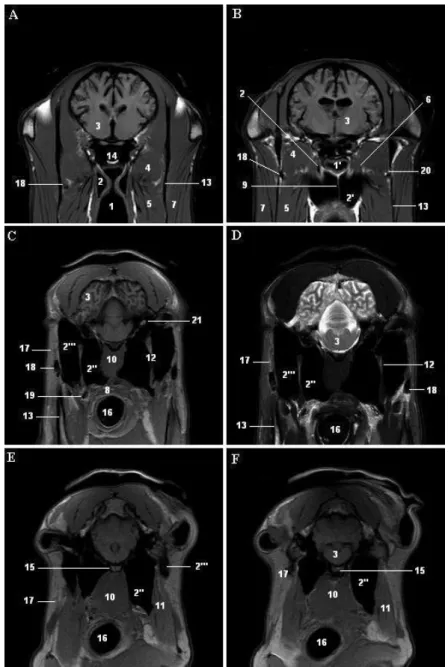 Figure 2. T1-weighted (A, B, C, E, F) and T2-weighted (D) transversal magnetic resonance images that it levels are described in  midsagittal section of the figure 1