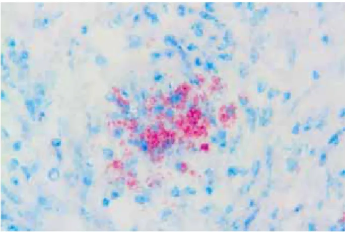 Fig 3. Appearance of AFB in the lung, ZN, x400.  Şekil 3. Akciğerde AFB’nin görünümü, ZN, x400