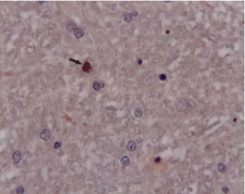 Figure 2. Intranuclear inclusion bodies in astrocytes in  substantia alba (arrows), HE x400