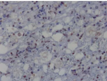 Figure 4. Apoptotic astrocytes, TUNEL stain, x100.  Şekil 4. Apoptotik astrositler, TUNEL boyama x100