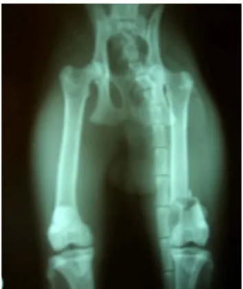 Şekil 2. Olgu no.4’de distal diyafizer femur kırığı  Figure 2. Case 4 distal diaphisis fracture of femur 