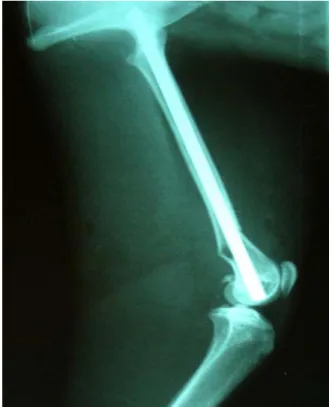 Şekil 4. Olgu no.40’da Bilateral ramus mandibulae kırığı  Figure 4. Case 40 bilateral fracture of ramus mandibulae 