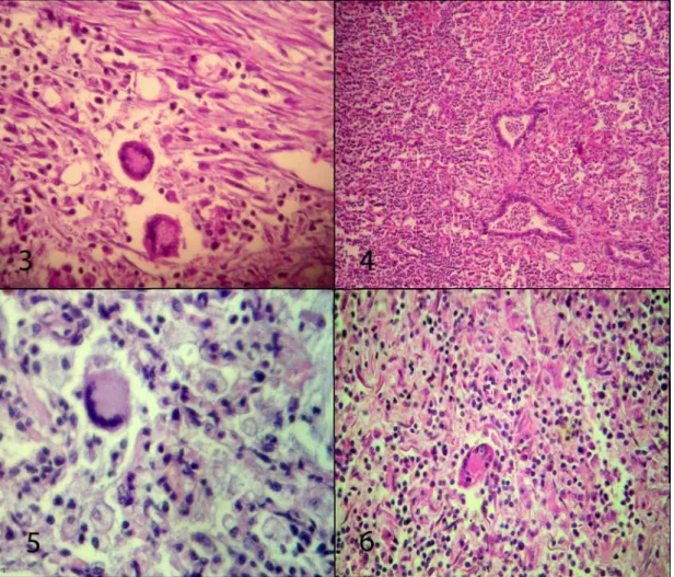 Figure 7. Lung, case number 5; immunopositive staining at macrophages against R. equi antiserum, ABC-P,1000x