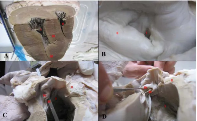 Şekil 1. Sığır kalbinde hipertrofi ve açık foramen ovale 