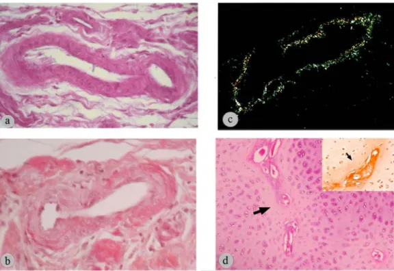 Figure 1. Clinical appearance a. Unable to stand (thins arrows, I.Group)- Able to stand (thicks arrow, Group II),  Appearance of  joints: b.Severe swelling (thicks arrow, I
