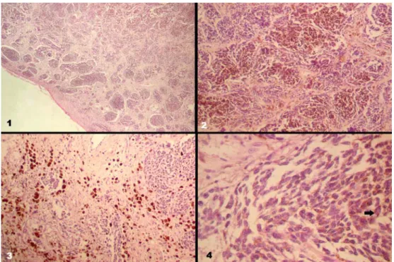 Figure 2. (1) General appearence of tumor cells in lamina propria, HE x40 