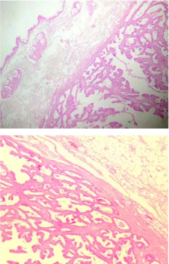 Figure 3. Cystic adenoma papilliferum in the mammary gland.  Hematoxylin and Eosin; 40x