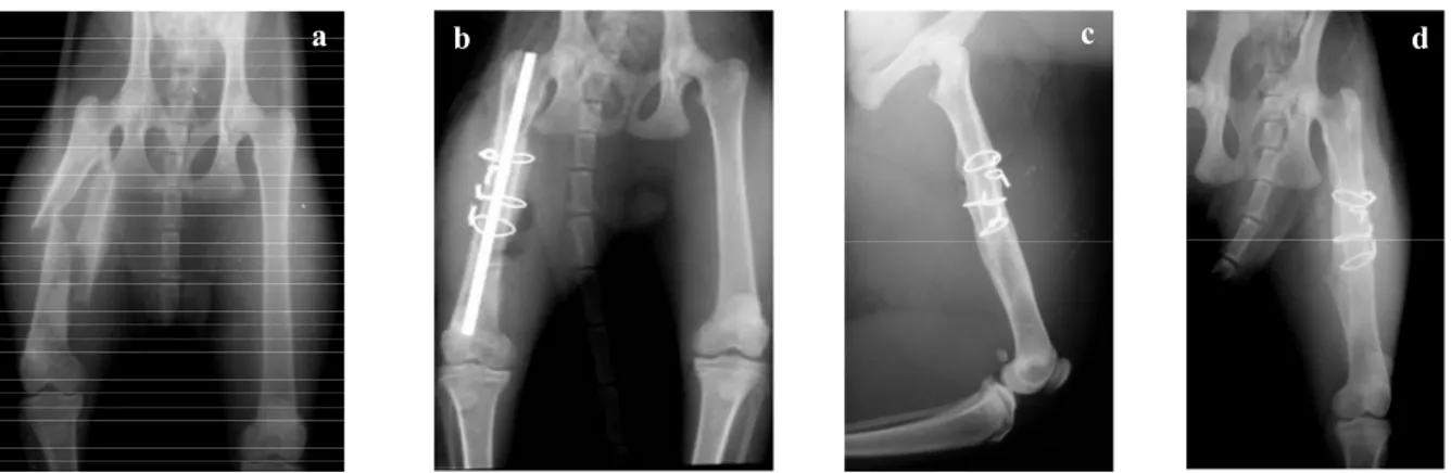 Figure 2. X-rays of case no:15 taken preoperatively (a), 2 nd  (b) and 4 th  week postoperatively (c – cerclage wire failure between the 