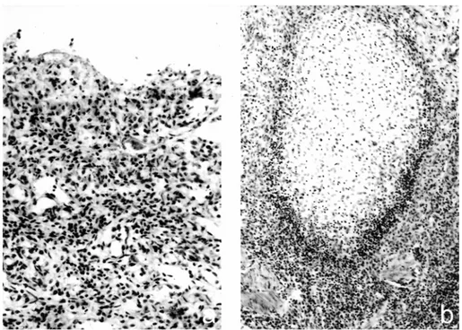 Şekil 1. (a) Villuslarda kütleşme, propria mukozadaki bezlerde atrofi ile birlikte mononüklear hücre infiltrasyonu ve fibrosit  proliferasyonu