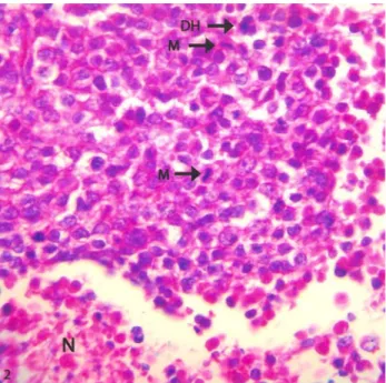 Şekil 2.  Sağ testiste anaplastik hücreler, mitotik figürler (M),  çok çekirdekli dev hücresi (DH) ve nekroz (N) HE X 400