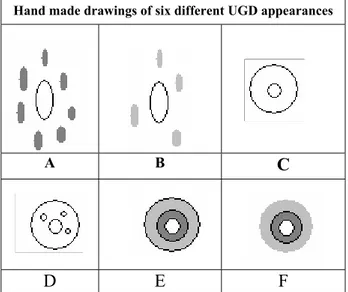 Figure 1. Morphological classifications of the unfertile germi- germi-nal disc (UGD) 