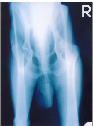 Figure 5. Case 12 ventrodorsal radiographic view of right hip  joint luxation after on closed reduction 