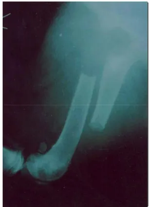 Şekil 1. Olgu no: 14’ün sol femur’undaki diafizer orta 1/3  kırığının preoperatif M/L  radyografik görünümü