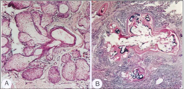 Figur 2. Case 1. Sebaceous gland adenoma (Şekil 2. Yağ bezi adenomu). A. Sebaceous gland adenoma at the periphery of  the lipid gland duct consisting of generative cells and mature sebaceous cells, HE x200