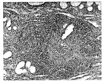 Şekil 2. Tubuııerdc dilatasyon ve intersitisyel aralıklarda mo- mo-nonüklear hücre infiltrasyonu, korteks