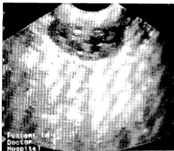 Figure 7. Pelvie dilatation and parti al eehogenicity wiıh enlarged and irregular arehiteetme in ultrasonography.
