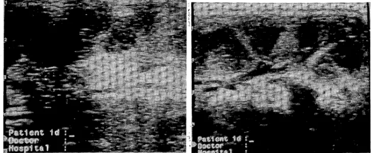 Figure 5. A patehy hyperechoic cortex and poor demareation between eortex and meduııa in ultrasonography.