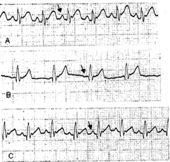 Figure 2. ECG traees taken from a rabbit of norepinephrine group (A: Before KCl infusion, B: Hyperkalemia stage, c: Af ter norepineplırine applieation)