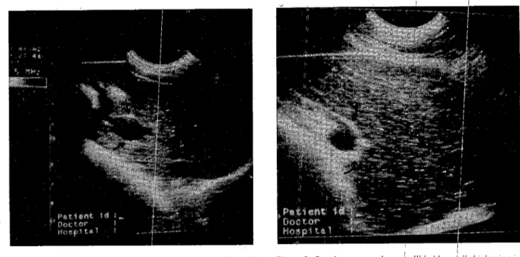 Figure 2. On ultrasonography. a Igaııbladder~all ıhickening is seen, which is shown by the cur~ed arrows