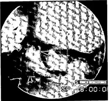 Figure 6. Intraartieular suhstanees are emered witiı pu'; and rıb- rıb-rin i n the earpa! jüi nt.