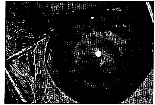 Figure 4. Appearanee of the autogenic graft on postop cration 30th day.
