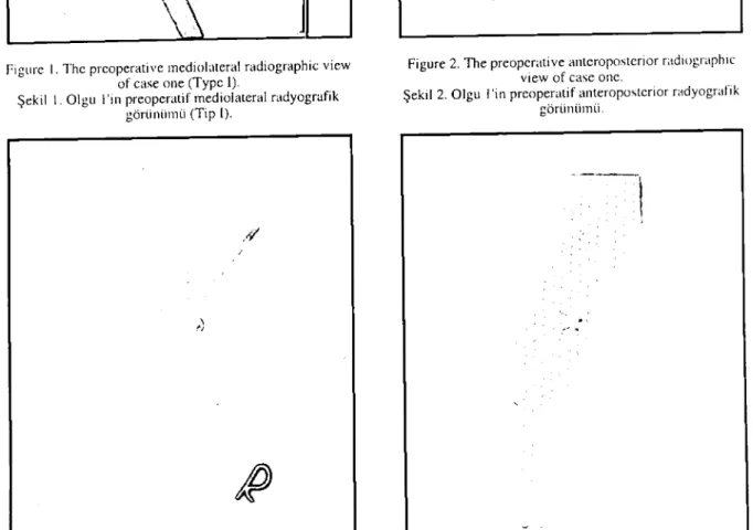 Figure 4. The postoperative anteroposıerior radiogr~\phıc view of case one.