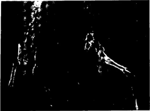 Table I. Findings and results abouı ıhe cases. Tablo I. Olgulara aiı bulgular ve sonuçlar