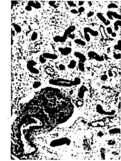 Figure 5. Fibrotic glandular nest and dilated glands with inspissaıed secretion in fumens
