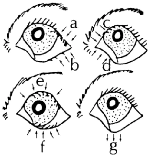 Figure 1.: Classitication of ıhe entrapion and ectropion cases accordıng lo localısation.