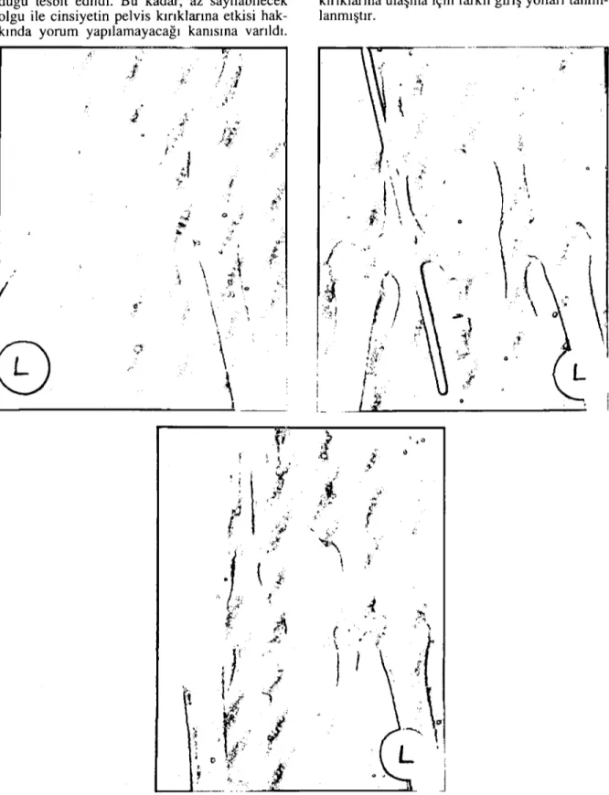 Şekil 2: 2'ncİ olgu'nun operasyon öncesi, ostcosentez uygulandıktan vc pin alındıktan sonraki radyolojik görünümleri
