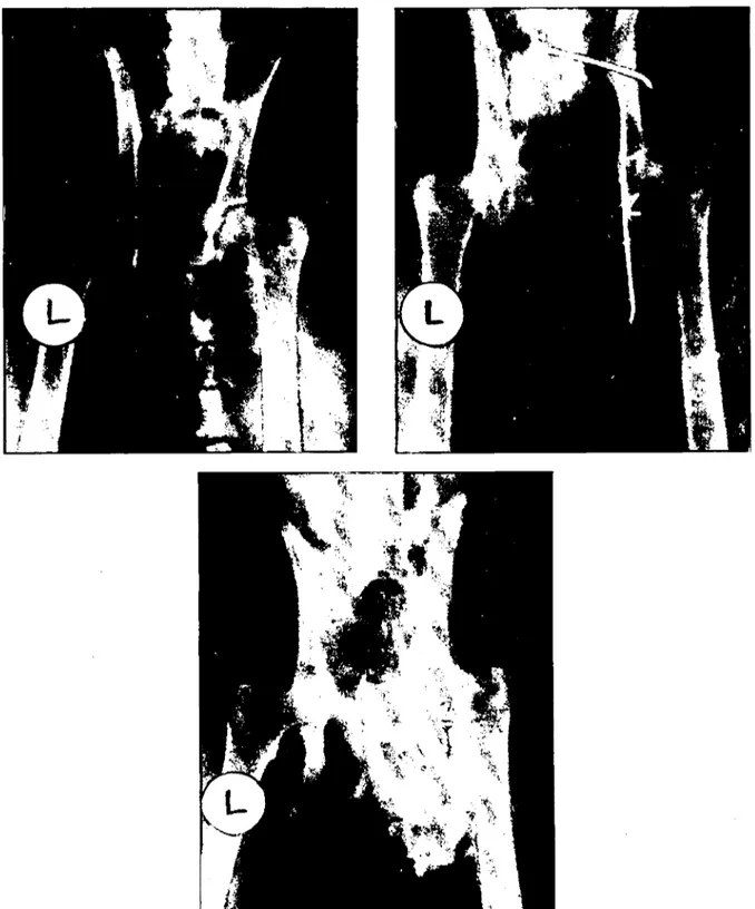 Şekil 3: 3'ncü olgu'nun operasyon öncesi ve sonrası radyolojik göıiinümleri.