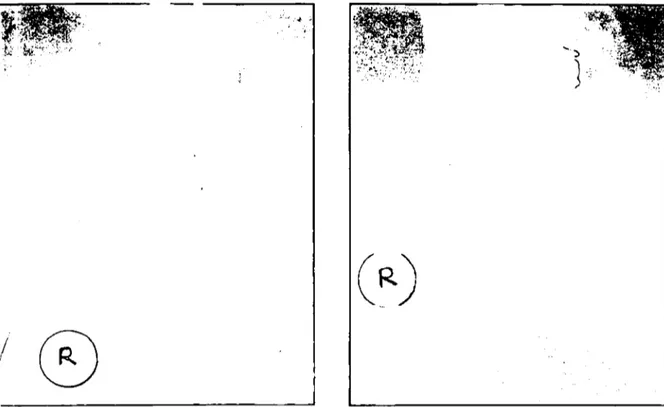 Şekil 6: l2'nci olgu'nun operasyon öncesi ve sonrası radyolojik görünümleri, Fig 6, Pre and post operative radiographie view of the 121h case,
