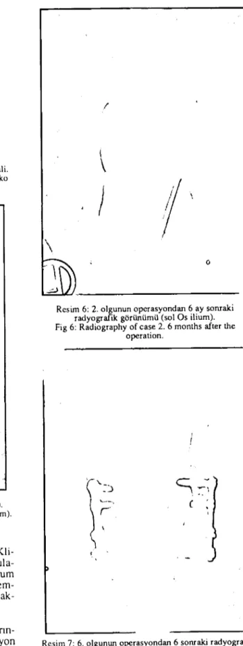 Fig 7: Radiography of case 6. taken 6 months af ter the operation.