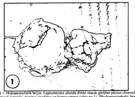 Şekil ı. Hidranensefalik beyin. Leptomeninx altında direkt olarak görülen plcxus choroideus ventriculi lateralis, nueleus caudatus ve hippocampus (olgu no I)