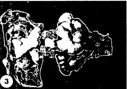 Şekil 3: Hidranensefalik beyin. Hippocampus ve nucleus caudatus liqour cerebrospinalis'in yaptığı basınç sonu çok küçülmüş ve yassılmış (Olgu no 3)