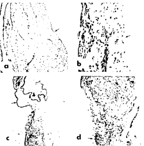 Şekil 7. a) Kalınl. hemisfcrik doku vc subvenıriküler alan ependim hücreleri ilc döşeli -ok- -ok-HEx~ (Residual hemispheric lissue and ependymal ceııs arranged lo ıhe subvenıricular lOn&#34; -arrow-) b) Artmış mezodermal fibriııer sonu skleroıik görünüm