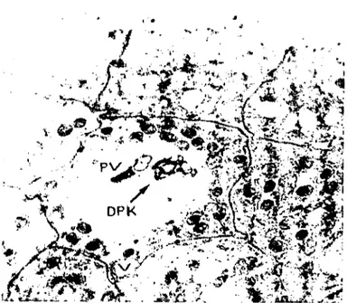 Şekil 7: Lamina epiıelialis hücresinde dejenere parazit kalınıısı bulunan parazitofor vakuol