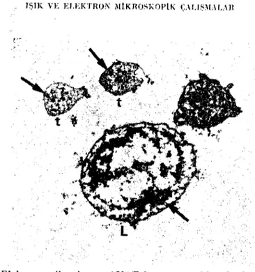 Şekil 6: Elcktraa mikmskapta ANAE hoyaması. oklar: lenfosit ve kan pu1cuklarında ANAE pozitif granüller, L: Icnfosit, t: kan pulcuğu