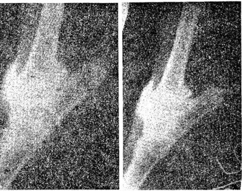 Fig 2. Radiologic wiev of the case, number 5 in the 30 th. min.