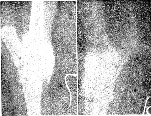 Şekil 3. 7 nolu olgunun 60. dakikadaki radyolojik görünümü. a) Sodium diatrizoate b) Iohcxol