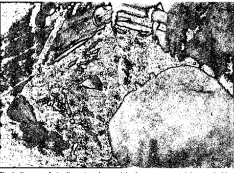 Fig. 2: Exposure of the liver; the pylonıs and duodenum were grasped downward with a moist sıerile drape.